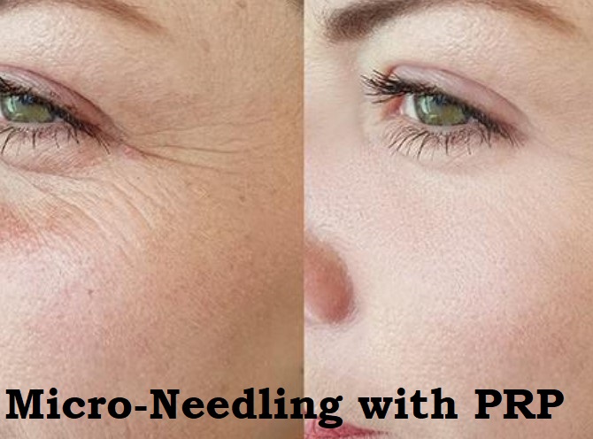 Micro-Needling with PRP